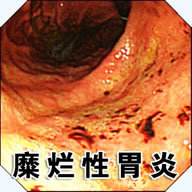 什么是糜烂性胃炎会疼痛吗